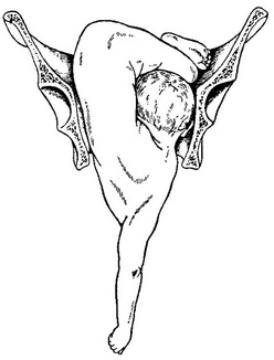 пологи складеним плодом