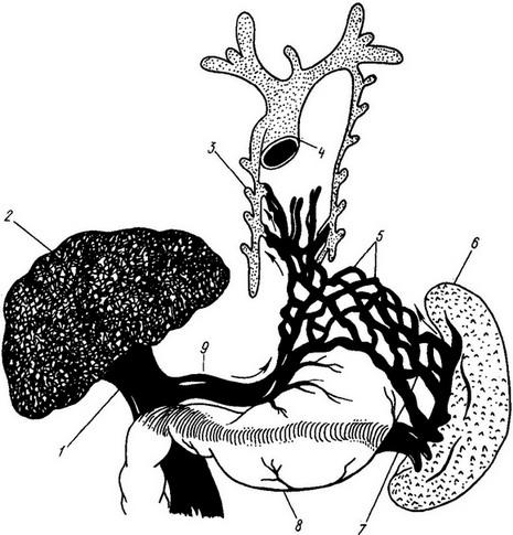венозні колатералі при цирозі печінки