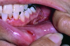 вульгарна пухирчатка