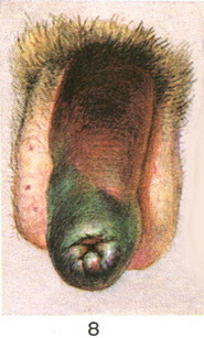 перелом статевого члена