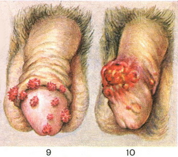 папіломи і рак статевого члена
