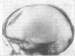 втиснутий перелом черепа