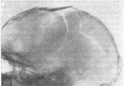 роздроблений перелом черепа