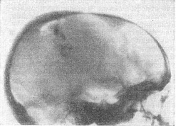 дірчастий перелом черепа