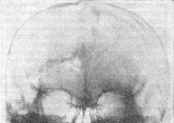 дірчасті переломи черепа