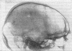 дірчасті переломи при сегментарному поранення черепа