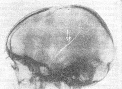 наскрізна тріщина черепа