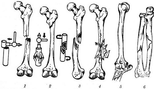 основні види переломів