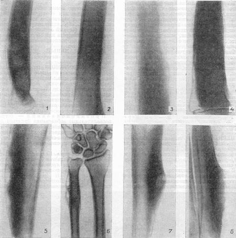 рентгенодіагностика періоститу