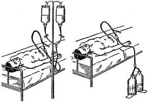 перитонеальний діаліз