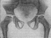 хвороба Пертеса