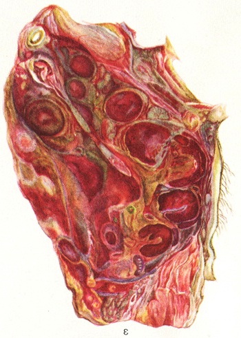 пахвовий бубон при чумі