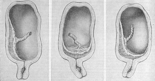 передлежання плаценти