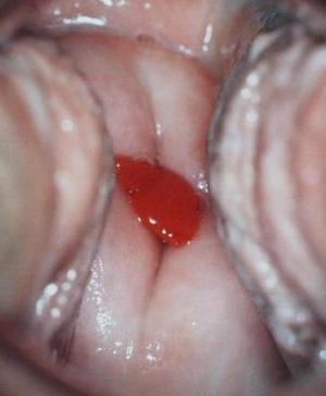 плацентарний поліп фото