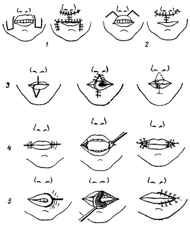 місцеві пластичні операції