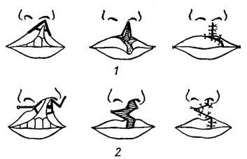 пластика при уроджених ущелинах верхньої губи