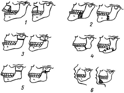 пластичні операції з приводу деформації щелеп