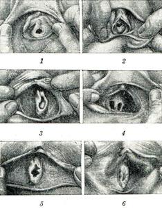 дівоча пліва