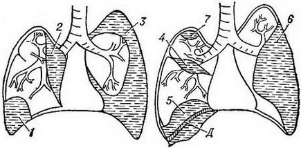 гнійний плеврит