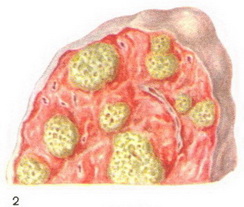 фридлендеровская пневмонія