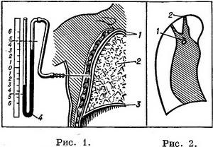 штучний пневмоторакс