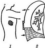 пневмоторакс