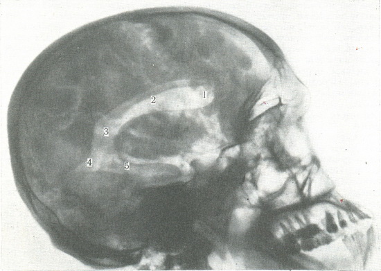 бічна пневмоэнцефалограмма