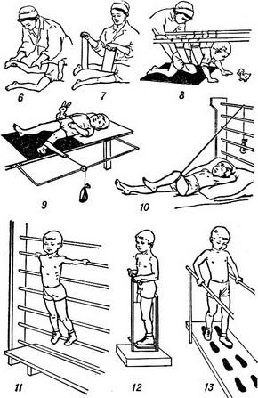 поліомієліт лфк