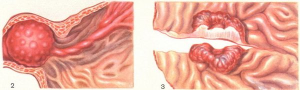 поліп шлунка
