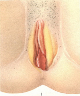 поліп сечовипускального каналу