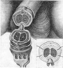 ампутація статевого члена