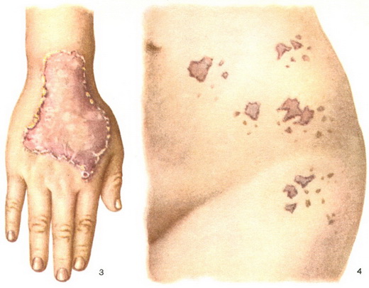 порокератоз