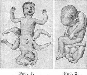 сіамські близнюки фото