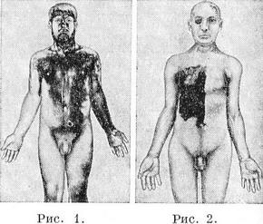 гіпергідроз, а підвищене