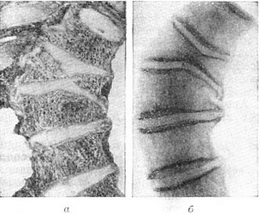 бабочковидный хребець