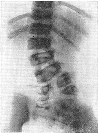 рахісхізис IV і V поперекових хребців