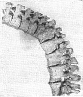 конкресценция