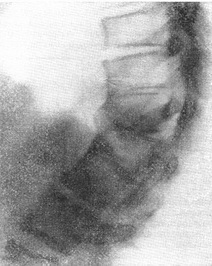 зрощення передніх відділів трьох грудних хребців