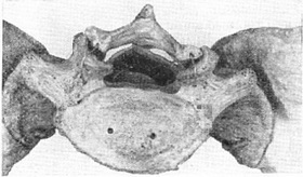 спонділоліз V поперекового хребця
