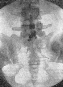 розрив міжостистої зв'язки хребта