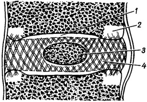 міжхребцевий диск схема