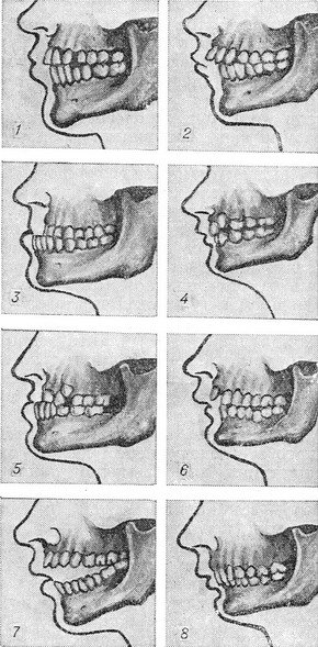 неправильний прикус
