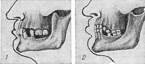 зниження прикусу