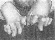 недиференційована проказа