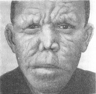 лепроматозная проказа