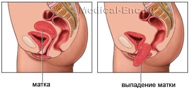 випадання матки піхви