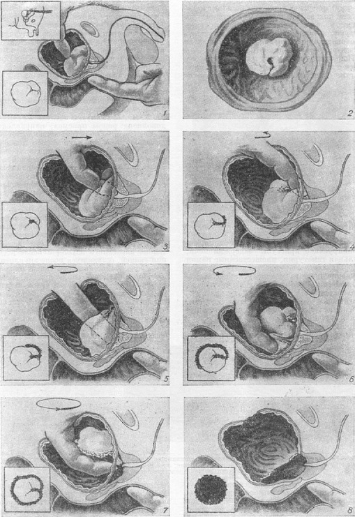 операція Фрейера