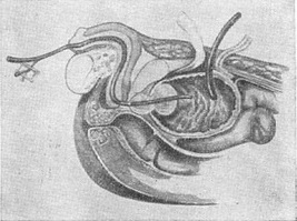 гемостатичний катетер