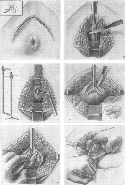промежинна аденомектомія