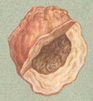 кіста передміхурової залози